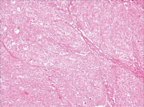 Microphotograph Of Squamous Cell Carcinoma Hematoxylin And Eosin ×100 Download High