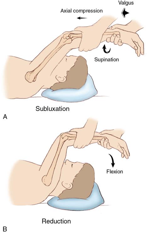 Surgical Treatment Of Posterolateral Rotatory Instability Of The Elbow