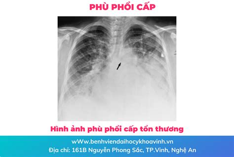 Triệu chứng triệu chứng phù phổi cấp nguyên nhân và cách chữa trị