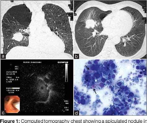 Figure 1 From Role Of Radial Endobronchial Ultrasound Guided