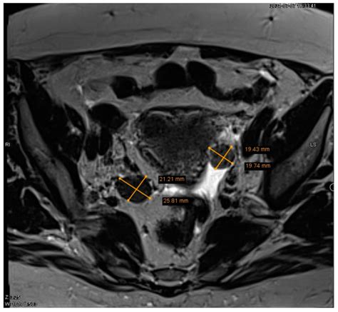 Ovarian Leydig Cell Tumor And Ovarian Hyperthecosis In A Postmenopausal