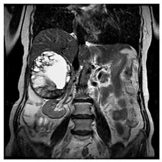 Abdominal MRI showing a large mass in the right adrenal gland in a ...