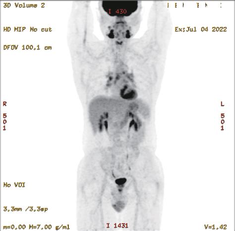 Figure 1 From Recurrent Submandibular Mass And Bilateral Periorbital