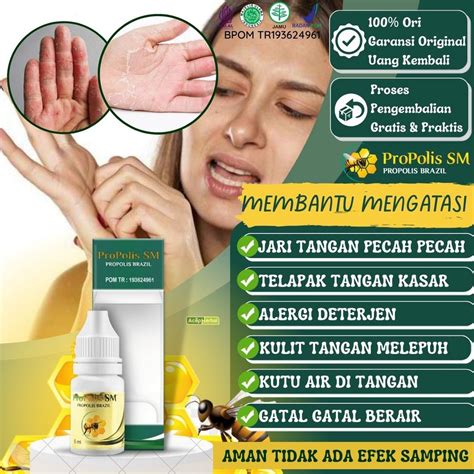 Jual Obat Jari Tangan Kering Dan Pecah Megar Bersisik Mengelupas Perih