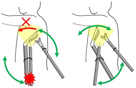 Comparison Of Two Different Instrumentations In 3 Incision Approach A