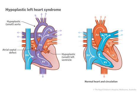 The X Man Our Journey With Hlhs Hypoplastic Left Heart Syndrome