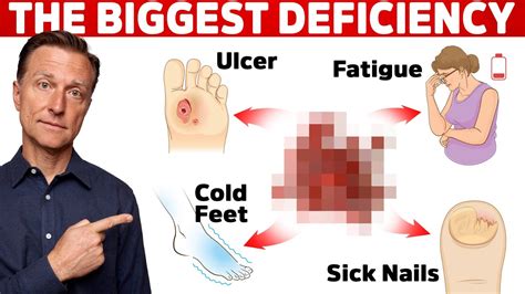 The 1 Most Common Mineral Deficiency In The World Youtube