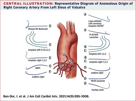 Jacc Journals On Twitter Where Is The Coronary Artery This State Of