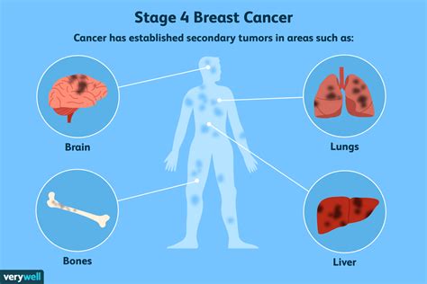 Traitements Locaux Des M Tastases Du Cancer Du Sein Fmedic