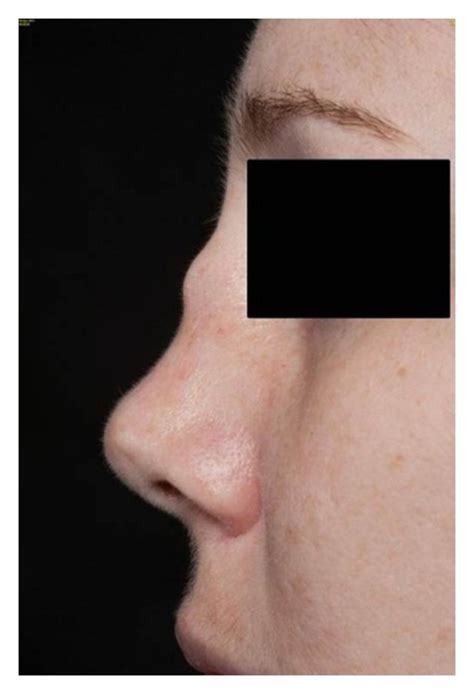 Acute Onset Saddle Nose Deformity Due To Inflammation Of The Nasal