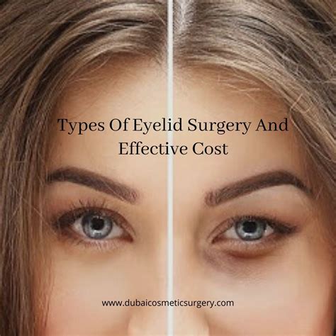 Pin On Eyelid Surgery