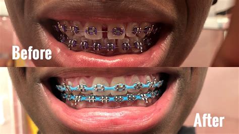 Before And After Braces Gaps