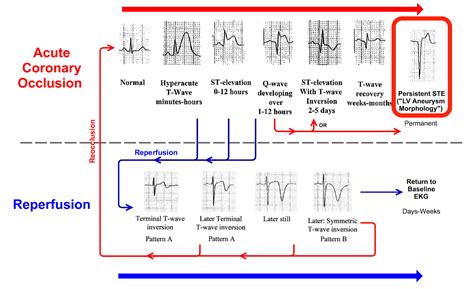 Dr Smith S Ecg Blog A Tale Of Occlusions In The Same Patient One