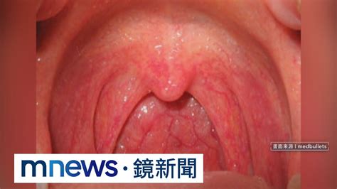 又是黴漿菌？扁桃腺紅腫發炎 醫：多為腺病毒｜鏡新聞 Youtube