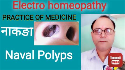 Electro Homeopathy Practice Of Medicine Nasal Polyps नाक का मांस