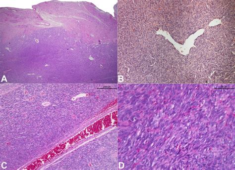 Photomicrographs Of The Biopsy Specimen Show A A Dense Proliferation