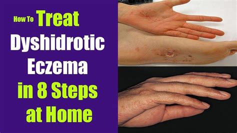 How to Treat Dyshidrotic Eczema in 8 Steps at Home | Eczema, Eczema ...