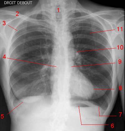 Chest X Ray AP Projection Diagram Quizlet