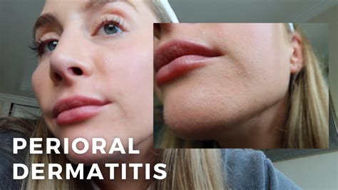 Perioral Dermatitis What To Know Skincare An Esthetician S