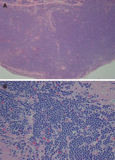 Massive Ascites As A Presenting Manifestation Of Chronic Lymphocytic