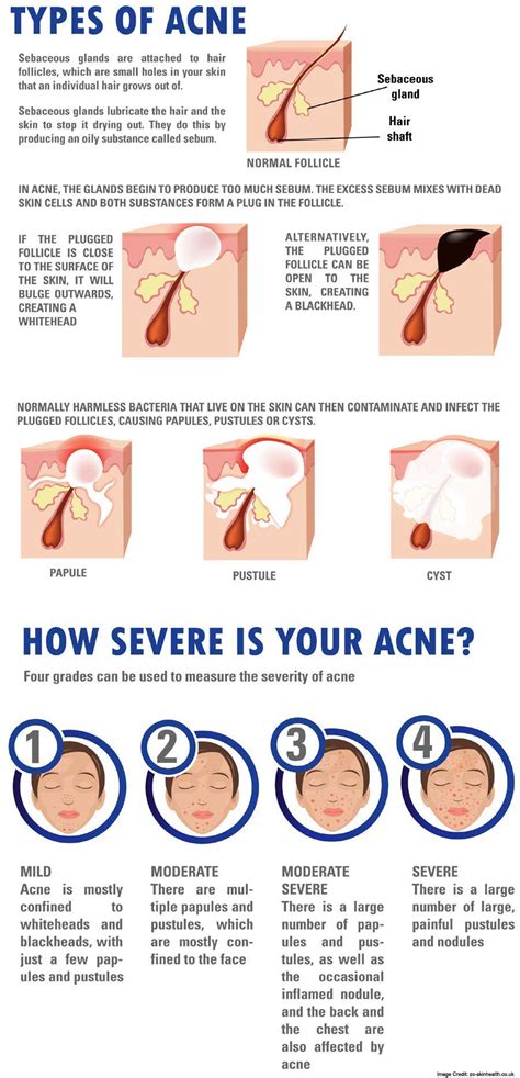 Acne: Types, Symptoms, Causes & Treatments