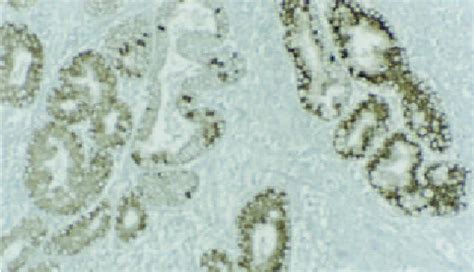 Immunohistochemical Staining For The Expression Of Survivin In Human