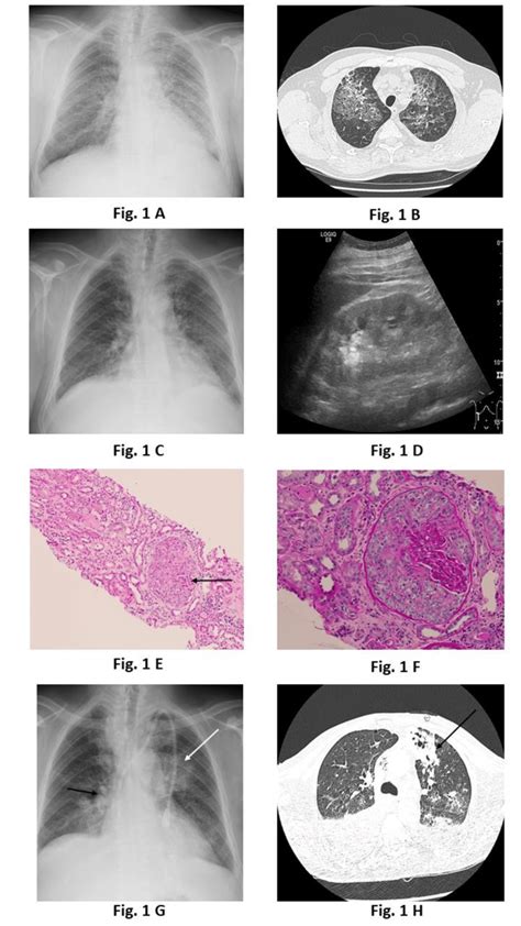 A X Ray Of The Chest Ground Glass Opacities In The Medial And Lower Download Scientific