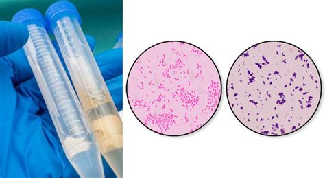 Gram Smear Of Cerebrospinal Fluid Csf Sample Microbiology