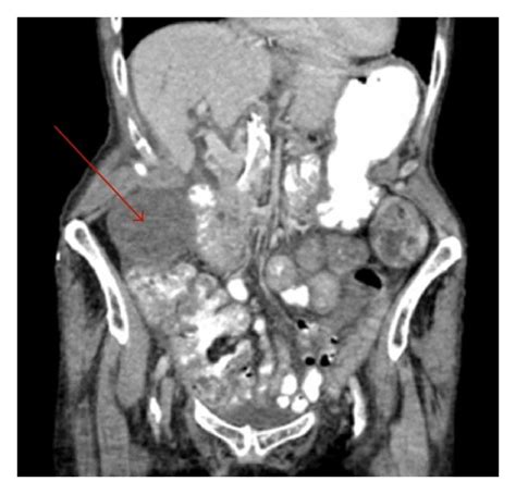 Intraoperative Image Of Gallbladder Torsion Intraoperative Picture Download Scientific Diagram