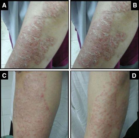 Mild Psoriasis Arms