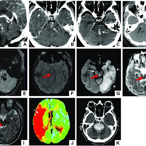 Compression features associated with Duret hemorrhage on brain imaging ...