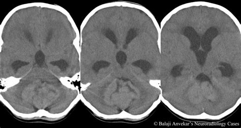 Dr Balaji Anvekar Frcr Fourth Ventricular Mass Mri