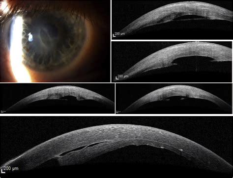 Descemet Membrane Detachment A Novel Concept In Diagnosis And