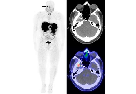 Mayo Clinic Clinical Trials In Patients With Tumor Induced Osteomalacia