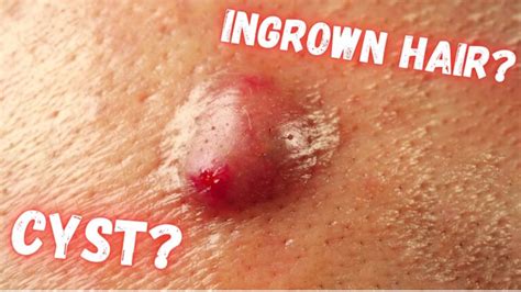 Ingrown Hair Turned Into Hard Lump Under Skin What Is It And How To Treat It Feminine Health