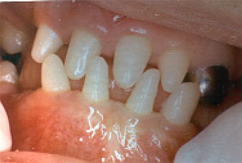 Oral Path Week Developmental Abnormalities Of Teeth Flashcards Quizlet