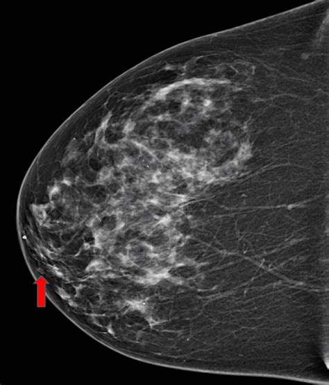 Adenosquamous Carcinoma Of The Breast Case Report And Literature