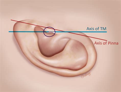 Postauricular Incision Oto Surgery Atlas