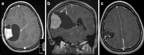 Mixed Meningothelial Microcystic Meningioma Containing A Large Download Scientific Diagram