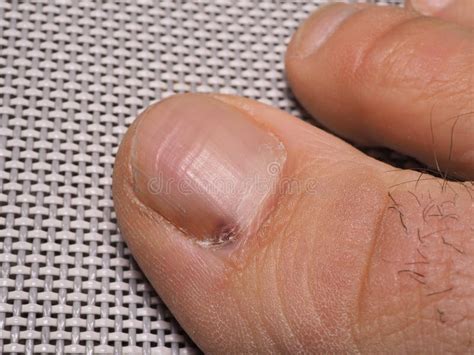 Nail Infections Caused By Fungi Such As Onychomycosis Also Known As Tinea Unguium Thumb