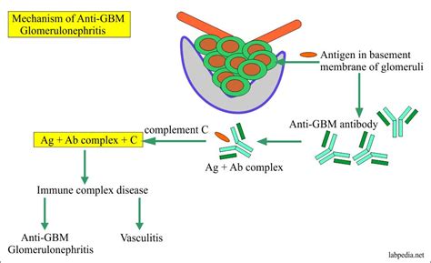 What Is Anti Glomerular Basement Membrane Disease Openbasement