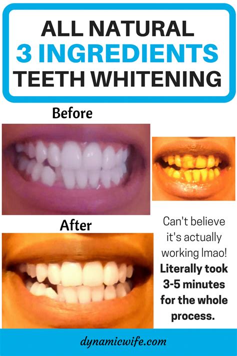 Teeth Treat Do It Yourself Teeth Whitening Kit