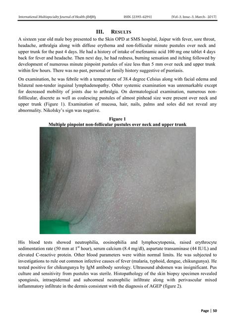 Mefenamic Acid Induced Acute Generalized Exanthematous Pustulosis Agep