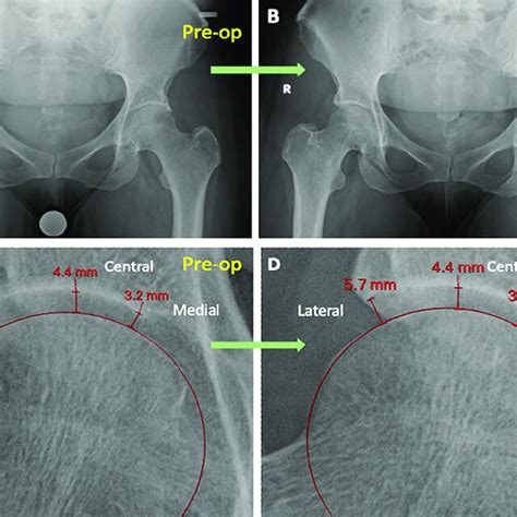 A Preoperative And B 2 Week Postoperative Supine Ap Pelvis