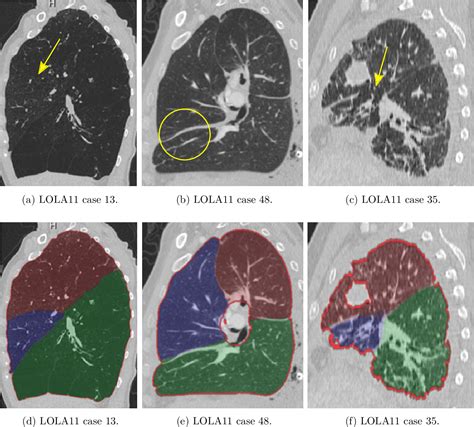 Figure 12 From Automatic And Interactive Segmentation Of Pulmonary Lobes And Nodules In Chest