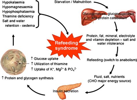 Pathogenesis And Features Of The Refeeding Syndrome Download