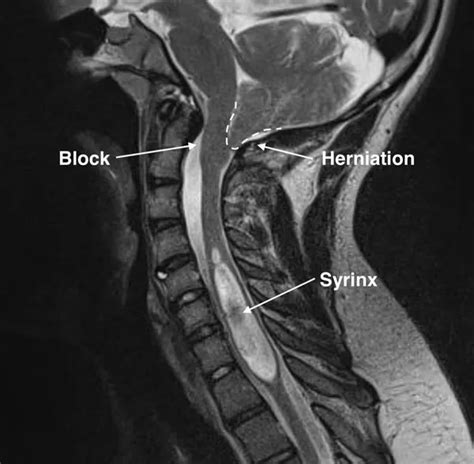 Chiari Malformasyonu Tip Belirtileri Ve Nedenleri