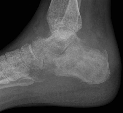 Primary Mycetoma Osteomyelitis Of The Calcaneus With Active Subcutaneous Nodules The Journal