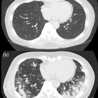 Bronchoscopy. (a) Transbronchial biopsy was performed through the left... | Download Scientific ...