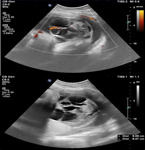 A Giant Early Second‐trimester Placental Chorioangioma Associated With